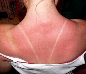 Woman with sunburn