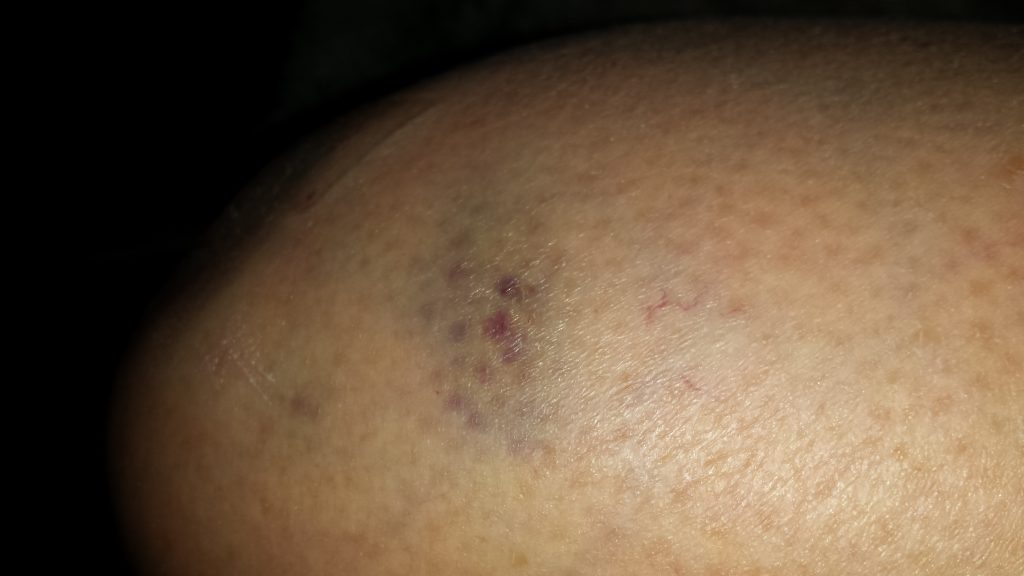 Bernie delegate's fading bruise five days after being pushed into metal fram by Hillary delegate.