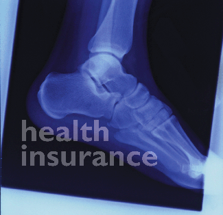 Insurance Providers were up on Capital Hill today trying to explain why they used “Recision Techniques” every chance they got.  For those that don’t know……but may have to find out […]